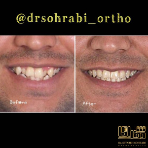 ارتودنسی-دندان-1