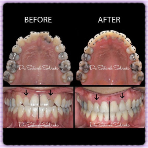ارتودنسی-دندان-103