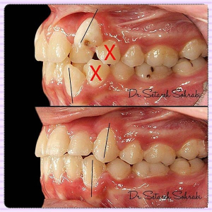 ارتودنسی-دندان-107