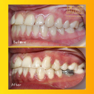 ارتودنسی-دندان-11