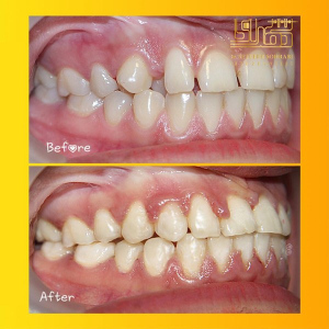 ارتودنسی-دندان-12
