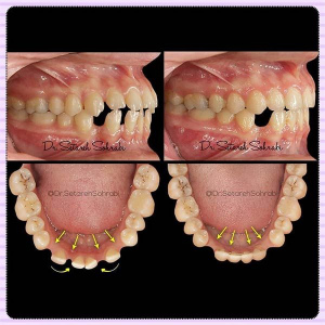 ارتودنسی-دندان-129