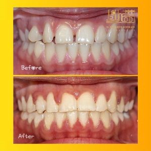 ارتودنسی-دندان-13