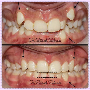 ارتودنسی-دندان-135