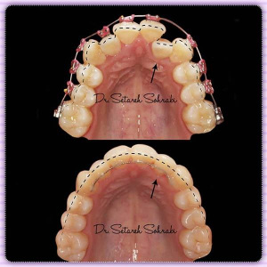 ارتودنسی-دندان-139