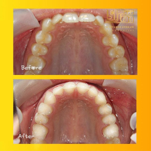 ارتودنسی-دندان-14