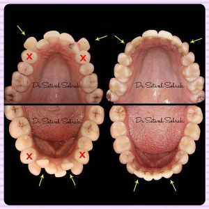 ارتودنسی-دندان-145