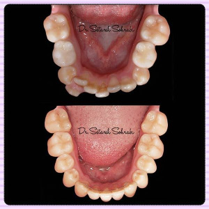 ارتودنسی-دندان-146