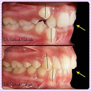 ارتودنسی-دندان-148