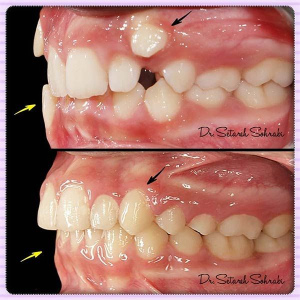 ارتودنسی-دندان-149