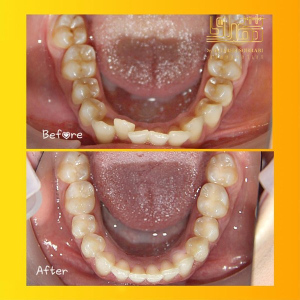 ارتودنسی-دندان-15