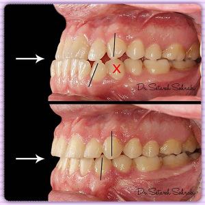 ارتودنسی-دندان-152