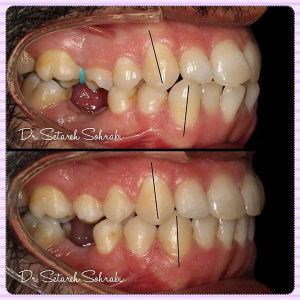 ارتودنسی-دندان-154