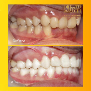 ارتودنسی-دندان-16