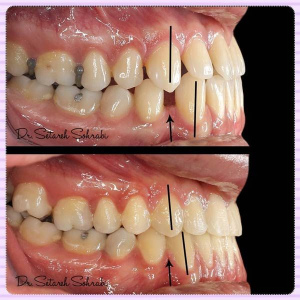 ارتودنسی-دندان-162