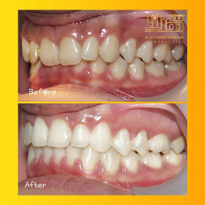 ارتودنسی-دندان-17