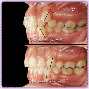 ارتودنسی-دندان-173