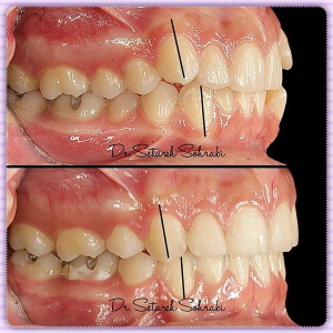 ارتودنسی-دندان-174