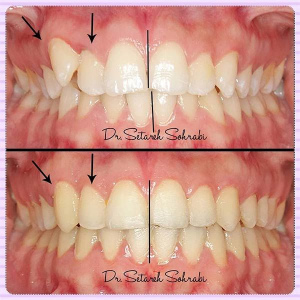 ارتودنسی-دندان-179