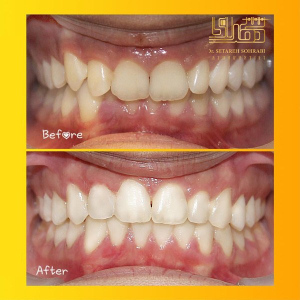 ارتودنسی-دندان-18