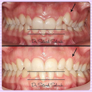 ارتودنسی-دندان-183