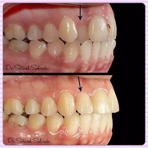 ارتودنسی-دندان-186