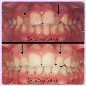 ارتودنسی-دندان-190