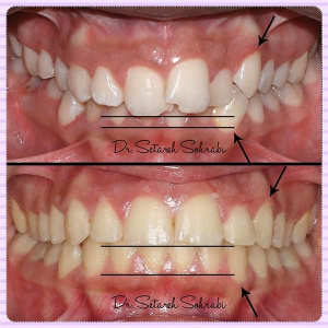 ارتودنسی-دندان-196