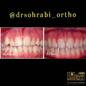 ارتودنسی-دندان-2