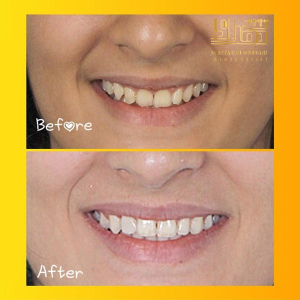 ارتودنسی-دندان-20
