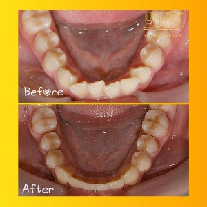 ارتودنسی-دندان-21
