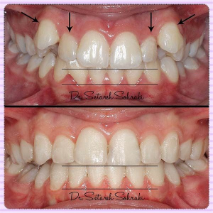 ارتودنسی-دندان-211