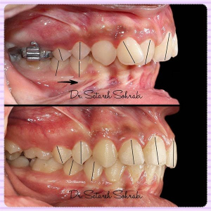 ارتودنسی-دندان-217