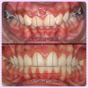 ارتودنسی-دندان-218