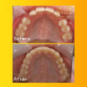 ارتودنسی-دندان-22