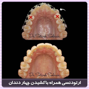 ارتودنسی-دندان-226
