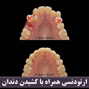 ارتودنسی-دندان-240
