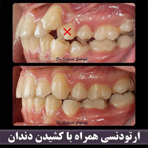 ارتودنسی-دندان-241