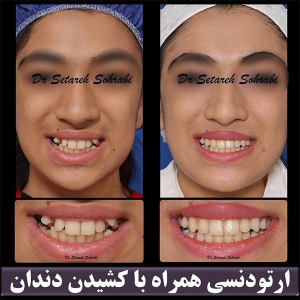 ارتودنسی-دندان-242