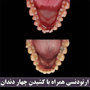 ارتودنسی-دندان-243