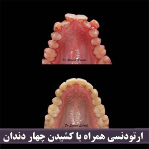 ارتودنسی-دندان-244