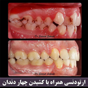 ارتودنسی-دندان-245