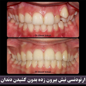 ارتودنسی-دندان-250