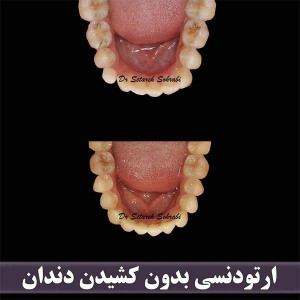 ارتودنسی-دندان-252