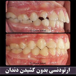 ارتودنسی-دندان-254