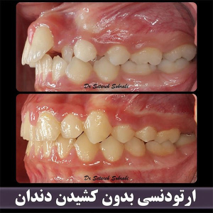 ارتودنسی-دندان-255