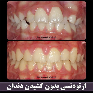 ارتودنسی-دندان-256