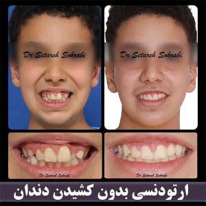 ارتودنسی-دندان-257