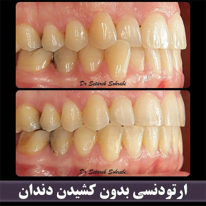 ارتودنسی-دندان-260