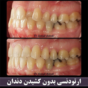 ارتودنسی-دندان-261
